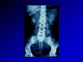 Litiasis Urinaria 1
