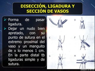 DISECCIÓN, LIGADURA Y
SECCIÓN DE VASOS
 Forma de pasar
ligadura.
 Dejar un nudo bien
apretado, con su
punto de sutura en el
extremo proximal del
vaso y un manguito
de x lo menos 1 cm.
En la parte distal tb
ligaduras simple y de
sutura.
 