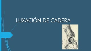 LUXACIÓN DE CADERA
 