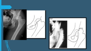 Luxación de cadera anterior, central y posterior  