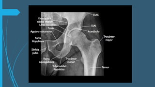 Luxación de cadera anterior, central y posterior  