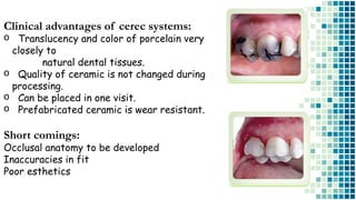 Clinical advantages of cerec systems:
o Translucency and color of porcelain very
closely to
natural dental tissues.
o Quality of ceramic is not changed during
processing.
o Can be placed in one visit.
o Prefabricated ceramic is wear resistant.
Short comings:
Occlusal anatomy to be developed
Inaccuracies in fit
Poor esthetics
 
