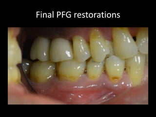 Final PFG restorations

 