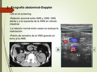 2.- Ecografía abdominal-Doppler
-Útil en el screening
-Relación anormal entre AMS y VMS: VMS
detrás y a la izquierda de la AMS en vólvulo
intestinal
-La relación normal entre vasos no excluye la
malrotación
-Patrón de remolino de la VMS girando en
torno a la AMS
ID
 