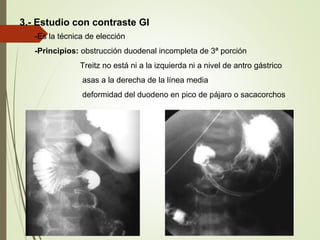 3.- Estudio con contraste GI
-Es la técnica de elección
-Principios: obstrucción duodenal incompleta de 3ª porción
Treitz no está ni a la izquierda ni a nivel de antro gástrico
asas a la derecha de la línea media
deformidad del duodeno en pico de pájaro o sacacorchos
 