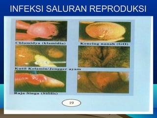INFEKSI SALURAN REPRODUKSI
 