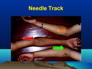 Needle Track
 
