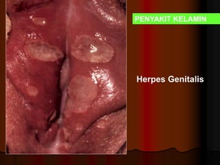 Herpes Genitalis
PENYAKIT KELAMIN
 