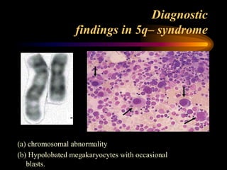 Diagnostic
findings in 5q– syndrome
(a) chromosomal abnormality
(b) Hypolobated megakaryocytes with occasional
blasts.
 
