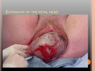 EXTENSION OF THE FETAL HEAD:
 
