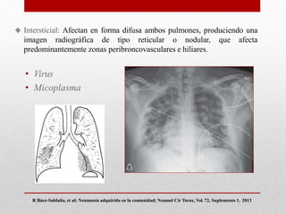 Intersticial: Afectan en forma difusa ambos pulmones, produciendo una
imagen radiográfica de tipo reticular o nodular, que afecta
predominantemente zonas peribroncovasculares e hiliares.
• Virus
• Micoplasma
R Báez-Saldaña, et al; Neumonía adquirida en la comunidad; Neumol Cir Torax, Vol. 72, Suplemento 1, 2013
 