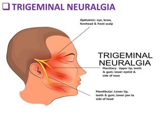 TRIGEMINAL NEURALGIA
 