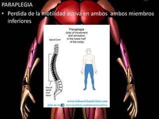 PARAPLEGIA
• Perdida de la motilidad activa en ambos ambos miembros
inferiores
 