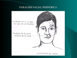 PARALISIS FACIAL PERIFÉRICA 
