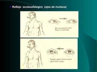 Reflejo  oculocefalogiro  (ojos de muñeca) 