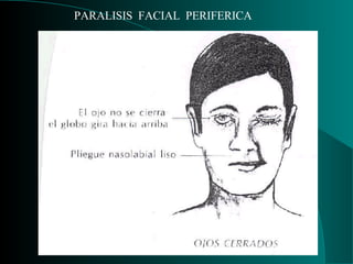 PARALISIS  FACIAL  PERIFERICA 