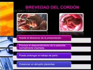 Impide el descenso de la presentación.
Provoca el desprendimiento de la placenta
normalmente insertada.
Puede prolongar el trabajo de parto.
Ocasionar un abruptio placentae.
 
