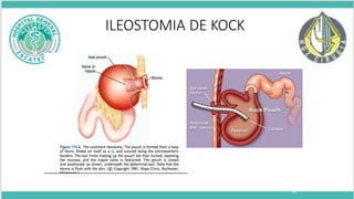 38
ILEOSTOMIA DE KOCK
 