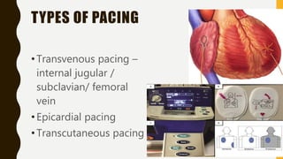 TYPES OF PACING
•Transvenous pacing –
internal jugular /
subclavian/ femoral
vein
•Epicardial pacing
•Transcutaneous pacing
 