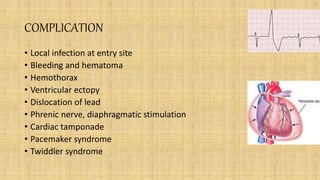 COMPLICATION
• Local infection at entry site
• Bleeding and hematoma
• Hemothorax
• Ventricular ectopy
• Dislocation of lead
• Phrenic nerve, diaphragmatic stimulation
• Cardiac tamponade
• Pacemaker syndrome
• Twiddler syndrome
 
