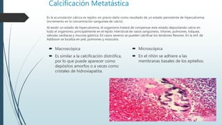 Calcificación Metatástica
 Macroscópica
 Es similar a la calcificación distrófica,
por lo que puede aparecer como
depósitos amorfos o a veces como
cristales de hidroxiapatita.
Es la acumulación cálcica es tejidos sin previo daño como resultado de un estado persistente de hipercalcemia
(incremento en la concentración sanguínea de calcio).
Al existir un estado de hipercalcemia, el organismo tratará de compensar este estado depositando calcio en
todo el organismo, principalmente en el tejido intersticial de vasos sanguíneos, riñones, pulmones, tráquea,
válvulas cardiacas y mucosa gástrica. En casos severos se pueden calcificar los tendones flexores. En la enf. de
Addisson se localiza en piel, pulmones y músculos.
 Microscópica
 En el riñón se adhiere a las
membranas basales de los epitelios.
 