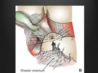 Peptic ulcer