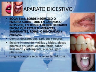 APARATO DIGESTIVO
• BOCA: Seca, BORDE NEGRUZCO O
PIZARRA SOBRE TODO EN CANINOS O
INCISIVOS, EN TODO EL BORDE DENTARIO
ENCIAS QUE ESTAN TUMEFACTAS,
SANGRANTES, ROJAS, O HINCHADAS Y
PALIDAS.
• Dientes descarnados, cariados y negros.
• En cara interna de mejillas y labios, placas
pizarra o azuladas. Aliento fétido, sabor
azucarado y astringente, a veces ligero
ptialismo.
• Lengua blanca y seca, a veces temblorosa.
 