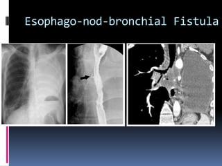 Esophago-nod-bronchial Fistula
 