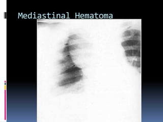 Mediastinal Hematoma
 