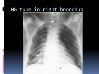 NG tube in right bronchus
 