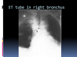 ET tube in right bronchus
 
