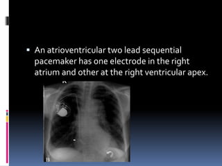  An atrioventricular two lead sequential
pacemaker has one electrode in the right
atrium and other at the right ventricular apex.
 