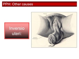 PPH: Other causes
Inversio
uteri:
 