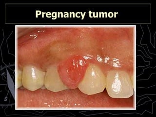 Pregnancy tumor   