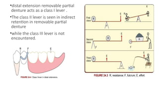 •distal extension removable partial
denture acts as a class I lever .
•The class II lever is seen in indirect
retention in removable partial
denture
•while the class III lever is not
encountered.
 