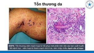 Tổn thương da
EGPA: Tổn thương viêm mạch hoại tử hồi phục một phần trên nền các ban xuất huyết.
Mô bệnh học: viêm hoại tử thành mạch nhỏ ở da, xâm nhập nhiều bạch cầu ái toan
Clinic Rev Allerg Immunol (2017) 53:428–438
 