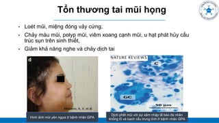 ĐẠI CƯƠNG
• Loét mũi, miệng đóng vảy cứng,
• Chảy máu mũi, polyp mũi, viêm xoang cạnh mũi, u hạt phát hủy cấu
trúc sụn trên sinh thiết,
• Giảm khả năng nghe và chảy dịch tai
Tổn thương tai mũi họng
Marzano, A. V, et al
Hình ảnh mũi yên ngựa ở bệnh nhân GPA
Dịch phết mũi với sự xâm nhập tế bào đa nhân
khổng lồ và bạch cầu trung tính ở bệnh nhân GPA
 