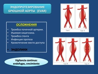 ОСЛОЖНЕНИЯ
• Тромбоз почечной артерии.
• Ишемия кишечника.
• Тромбоз стента
• Инфекция протеза
• Кровотечение место доступа
• ЭНДОЛИКИ
Vigilancia continua:
endofugas, crecimiento
ЭНДОПРОТЕЗИРОВАНИЕ
БРЮШНОЙ АОРТЫ (EVAR)
 