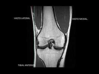 VASTO LATERAL. VASTO MEDIAL.
TIBIAL ANTERIOR.
 