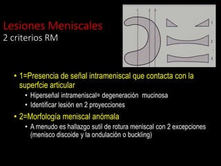 Lesiones Meniscales
2 criterios RM
• 1=Presencia de señal intrameniscal que contacta con la
superfcie articular
• Hiperseñal intrameniscal= degeneración mucinosa
• Identificar lesión en 2 proyecciones
• 2=Morfología meniscal anómala
• A menudo es hallazgo sutil de rotura meniscal con 2 excepciones
(menisco discoide y la ondulación o buckling)
 