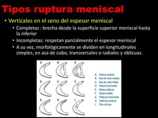 Tipos ruptura meniscal
• Verticales en el seno del espesor meniscal
• Completas : brecha desde la superficie superior meniscal hasta
la inferior
• Incompletas: respetan parcialmente el espesor meniscal
• A su vez, morfológicamente se dividen en longitudinales
simples, en asa de cubo, transversales o radiales y oblicuas.
 