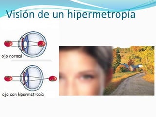 Visión de un hipermetropía
 