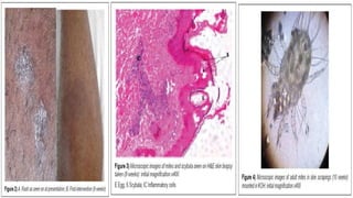 SCABIES CASE PRESENTATION