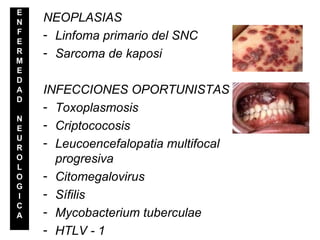 NEOPLASIAS Linfoma primario del SNC Sarcoma de kaposi INFECCIONES OPORTUNISTAS Toxoplasmosis Criptococosis Leucoencefalopatia multifocal progresiva Citomegalovirus Sífilis Mycobacterium tuberculae HTLV - 1 E N F E R M E D A D N E U R O L O G I C A 