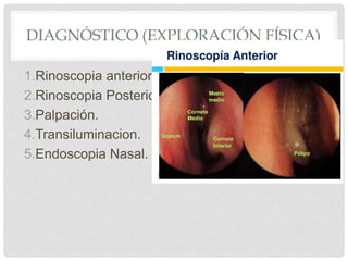 DIAGNÓSTICO (EXPLORACIÓN FÍSICA)
1.Rinoscopia anterior.
2.Rinoscopia Posterior.
3.Palpación.
4.Transiluminacion.
5.Endoscopia Nasal.
 