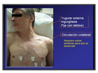 SINDROME MEDIASTINAL
