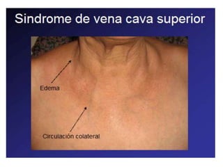 SINDROME MEDIASTINAL