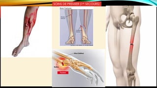 SOINS DE PREMIER (1er SECOURS)
 