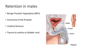 Retention in males
• Benign Prostatic Hyperplasia (BPH)
• Carcinoma of the Prostate
• Urethral Stricture
• Trauma to urethra or bladder neck
 