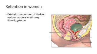 Retention in women
• Extrinsic compression of bladder
neck or proximal urethra eg
fibroid,cystocoel
 